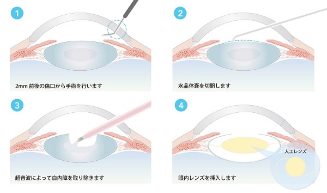 白内障手術の流れ