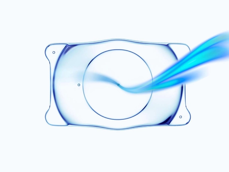 眼内コンタクトレンズ（ICL）